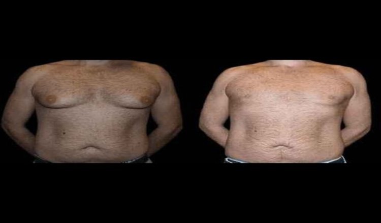 Gynecomastia Cost in Dubai: Factors That Affect Surgery Prices