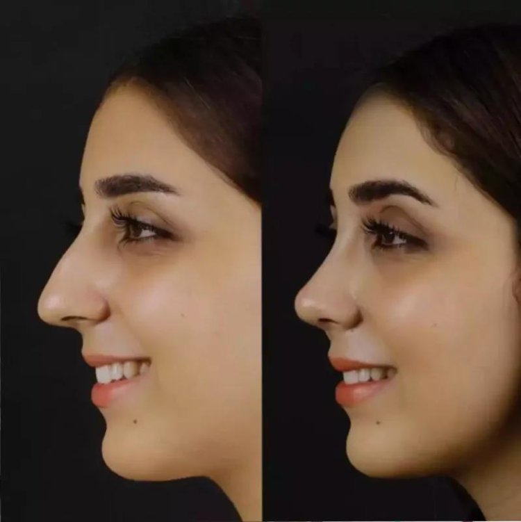 Rhinoplasty in Dubai: Precision Nose Surgery by Experts