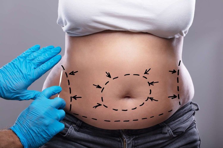 Debunking Common Myths About Tummy Tuck in Dubai