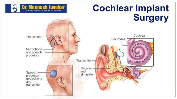 Finding the Best Cochlear Implant Surgeon in Navi Mumbai