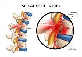 Spinal Cord Injuries: Causes, Symptoms, and Recovery