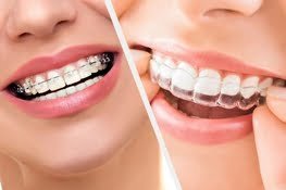 Say Goodbye to Metal Mouth: Discover the Benefits of Invisalign Braces in Bangalore