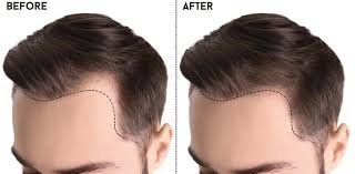 Step-by-Step Guide to the Unshaven Hair Transplant Procedure