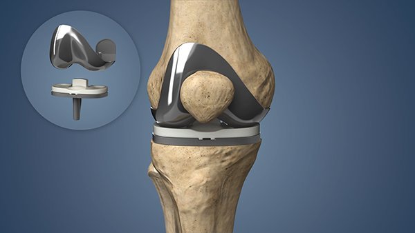 The Future of Orthopedics: Exploring 3D-Assisted Robotic Knee Replacement