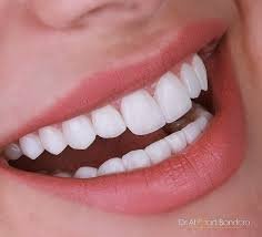 Are Veneers in Dubai the Secret to a Perfect Smile?