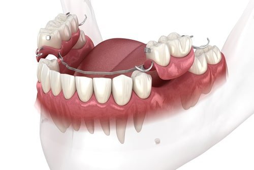 Single Tooth Dentures: Cost, Types & Benefits Guide