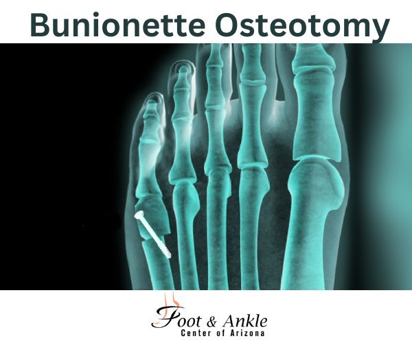 Why Are Bunionette Osteotomy Important for Treating Tailor’s Bunions?